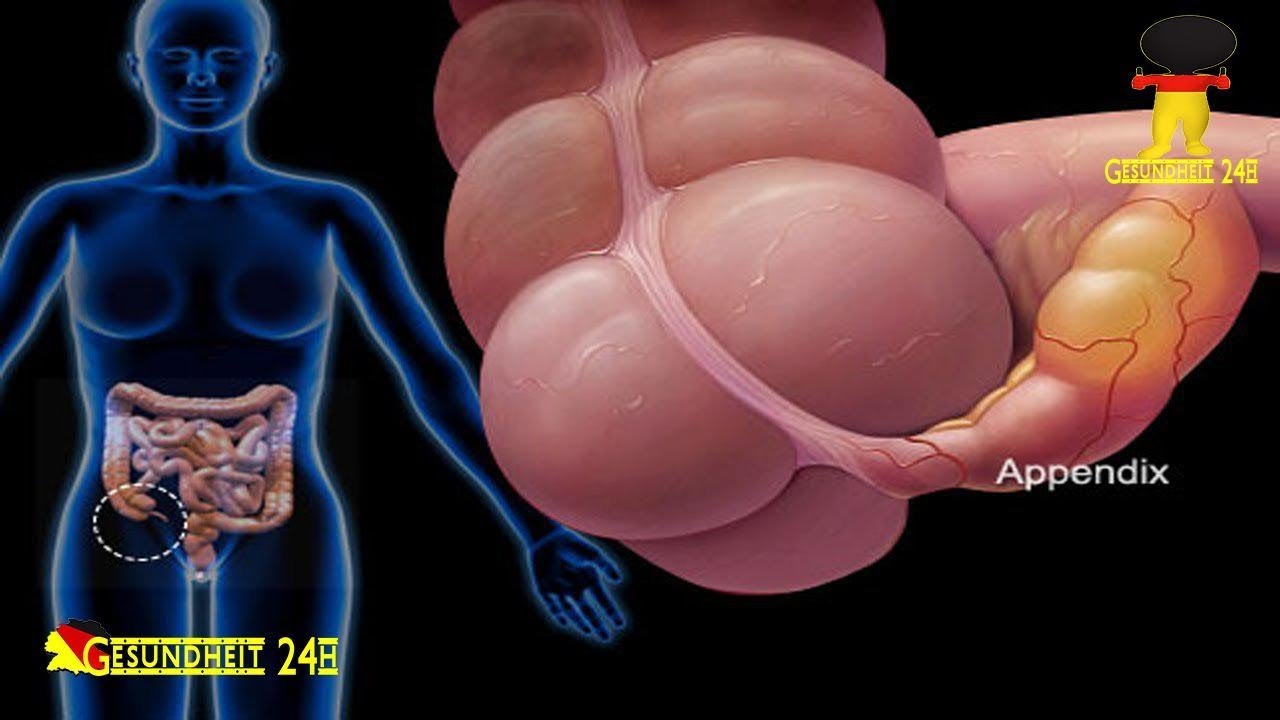 Bauchfellentzündung: Bei Peritonitis drohen Organschäden