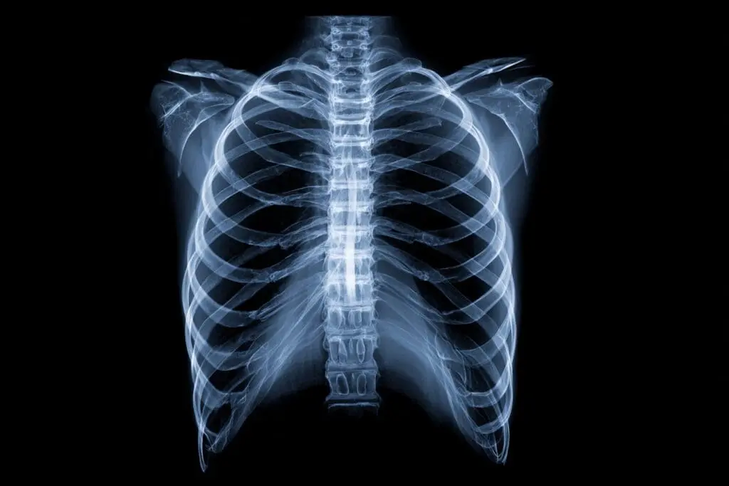 Ein Röntgenbild als Antwort auf Fragen zu vier rippen gebrochen wie lange krankenhaus Ein Röntgenbild als Antwort auf Fragen zu vier rippen gebrochen wie lange krankenhaus